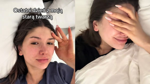 Influencerka zrobiła sobie operację, jak Julia Von Stein. Pokazała efekty